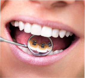 Lingual braces