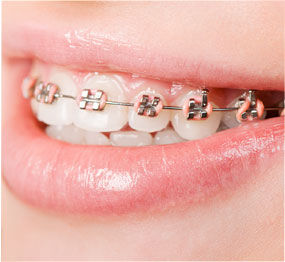 Metal braces